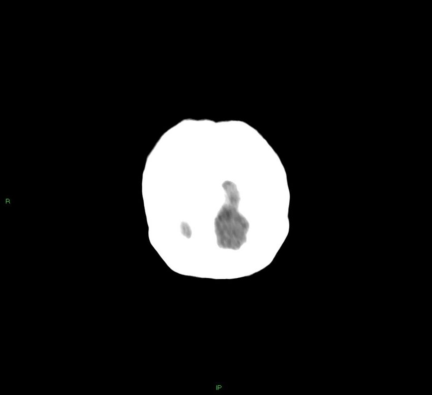 Basal ganglia hemorrhage (Radiopaedia 58766-65988 Coronal non-contrast 7).jpg
