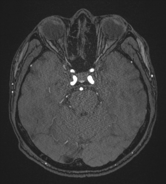 File:Basal ganglia subacute infarct (Radiopaedia 80201-93521 Axial MRA 39).png