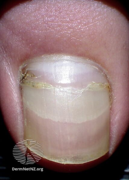 File:Beau lines seen in first left toenail (DermNet NZ beau-lines-2-v2).jpg