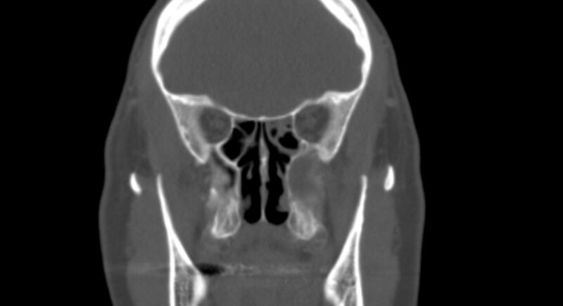 File:Benign mixed salivary tumor of the parotid gland (Radiopaedia 35261-36792 Coronal bone window 9).jpg