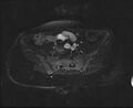 Bicornuate bicollis uterus (Radiopaedia 61626-69616 Axial PD fat sat 8).jpg