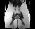 Bicornuate bicollis uterus (Radiopaedia 61626-69616 Coronal T2 34).jpg