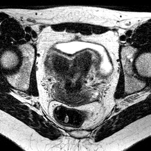 File:Bicornuate uterus (Radiopaedia 11104-11492 Axial T2 18).jpg