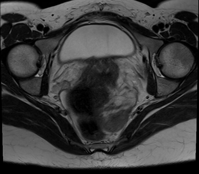 File:Bicornuate uterus (Radiopaedia 71214-81511 Axial T2 12).jpg