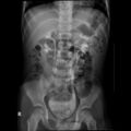 Bilateral duplex kidneys with left-sided uterocoele (Radiopaedia 20811-20725 Frontal 3).jpg