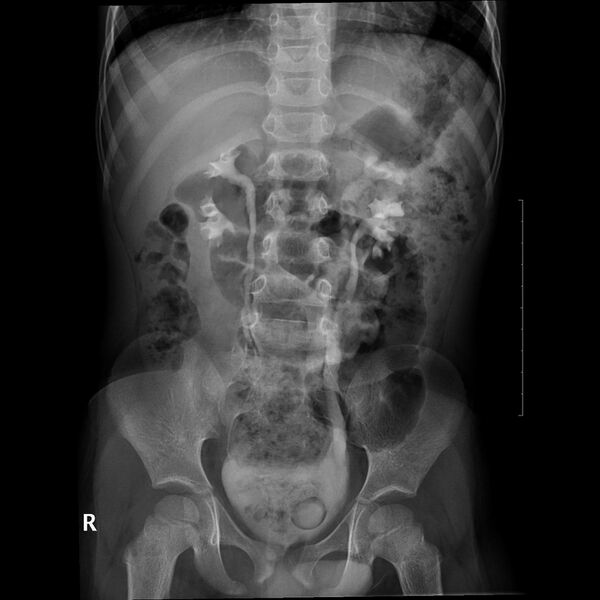 File:Bilateral duplex kidneys with left-sided uterocoele (Radiopaedia 20811-20725 Frontal 3).jpg
