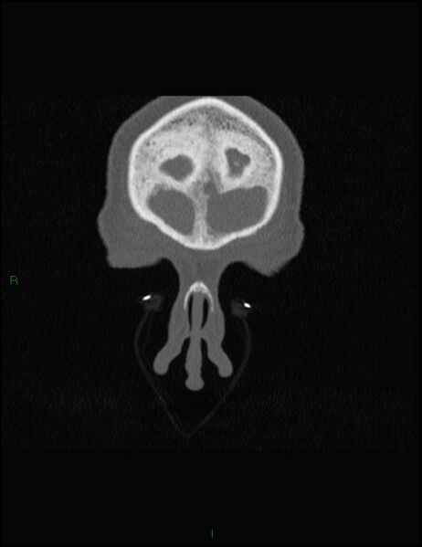 File:Bilateral frontal mucoceles (Radiopaedia 82352-96454 Coronal 40).jpg