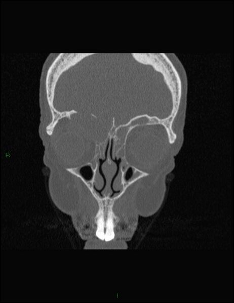 File:Bilateral frontal mucoceles (Radiopaedia 82352-96454 Coronal 97).jpg