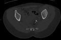 Bilateral mature cystic ovarian teratoma (Radiopaedia 88821-105592 Axial bone window 24).jpg