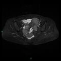 Bilateral ovarian fibroma (Radiopaedia 44568-48293 Axial STIR 15).jpg