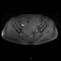 Bilateral ovarian fibroma (Radiopaedia 44568-48293 Axial T1 C+ fat sat 13).jpg