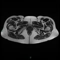 Bilateral ovarian fibroma (Radiopaedia 44568-48293 Axial T2 30).jpg