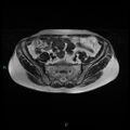 Bilateral ovarian fibroma (Radiopaedia 44568-48293 Axial T2 6).jpg