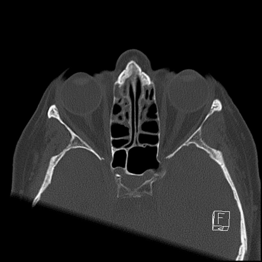 Bilateral palatine tonsilloliths on OPG and CT (Radiopaedia 75167-86247 Axial bone window 7).jpg