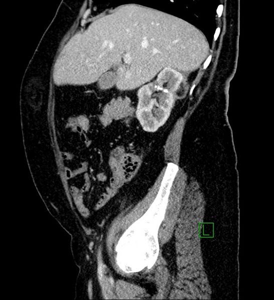 File:Bilateral sporadic synchronous clear cell renal cell carcinoma (Radiopaedia 85035-100575 G 81).jpg