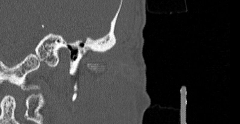 File:Bilateral temporal bone fractures (Radiopaedia 29482-29970 B 1).jpg