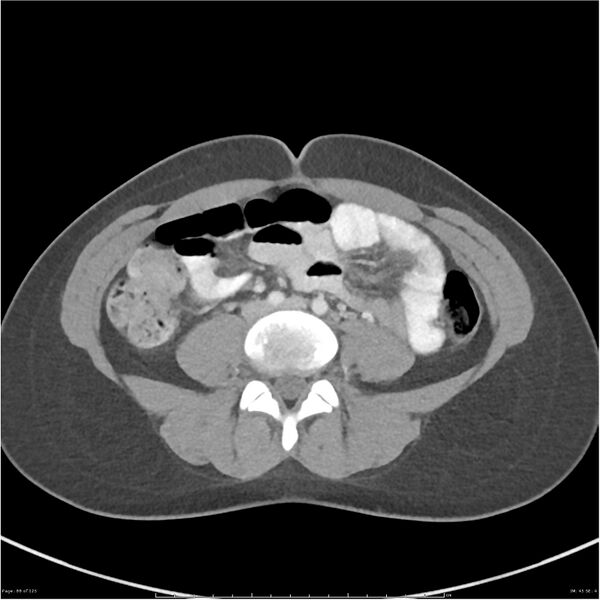 File:Bilateral ureteritis and cystitis (Radiopaedia 25340-25594 A 45).jpg