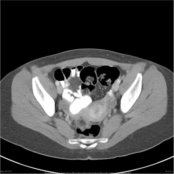 File:Bilateral ureteritis and cystitis (Radiopaedia 25340-25594 A 65).jpg