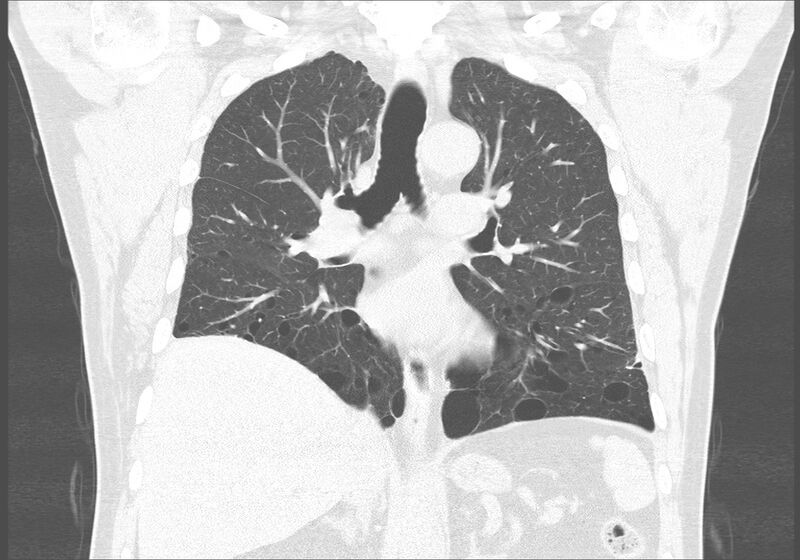 File:Birt-Hogg-Dubé syndrome (Radiopaedia 52578-58491 Coronal lung window 31).jpg