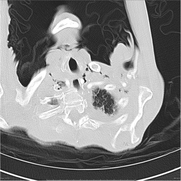 File:Boerhaave syndrome (Radiopaedia 26240-26362 Axial lung window 3).jpg