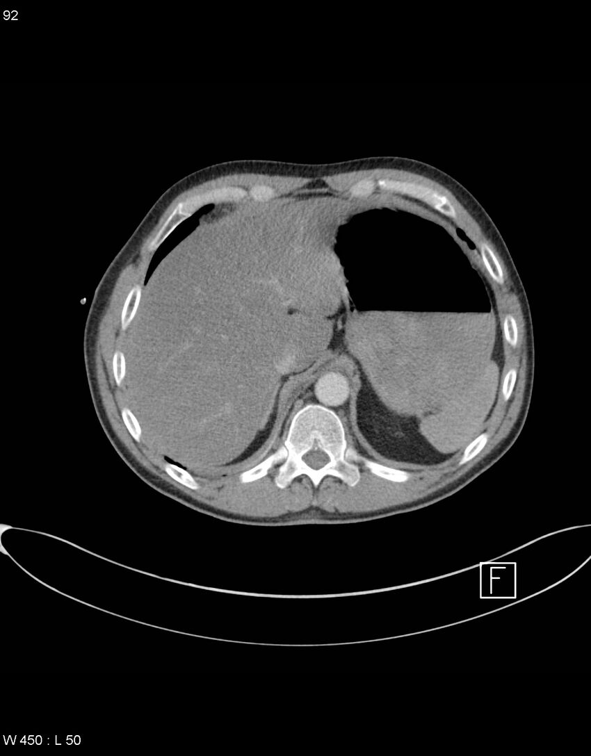Boerhaave syndrome with tension pneumothorax (Radiopaedia 56794-63605 A 45).jpg