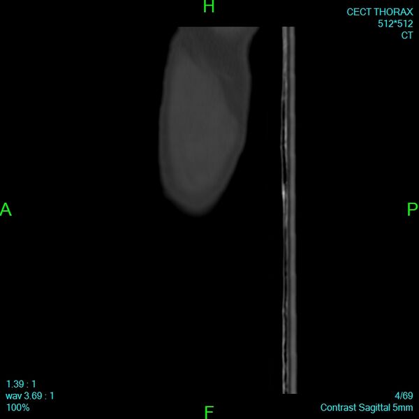 File:Bone metastases from lung carcinoma (Radiopaedia 54703-60937 Sagittal bone window 4).jpg