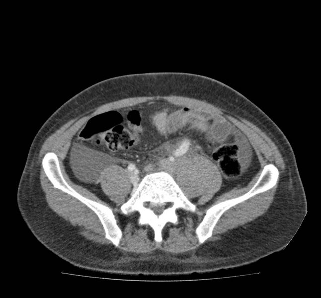 File:Bowel lymphoma complicated by bleeding after therapy (Radiopaedia 55601-62107 A 57).jpg