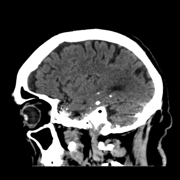 File:Brain Pantopaque remnants (Radiopaedia 78403-91048 C 41).jpg