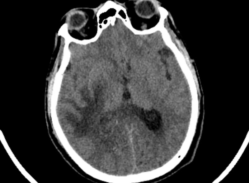 File:Brain abscess complicated by intraventricular rupture and ventriculitis (Radiopaedia 82434-96575 Axial non-contrast 43).jpg