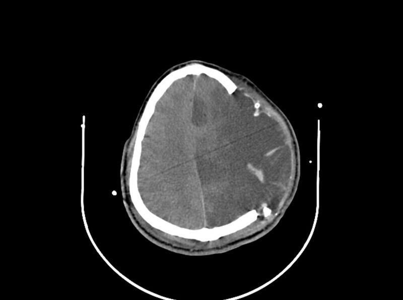 File:Brain injury by firearm projectile (Radiopaedia 82068-96087 B 135).jpg