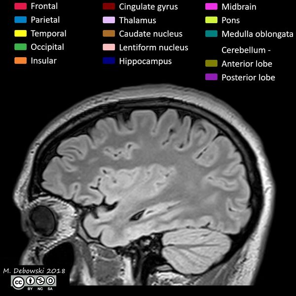 File:Brain lobes - annotated MRI (Radiopaedia 61691-69700 Sagittal 19).JPG
