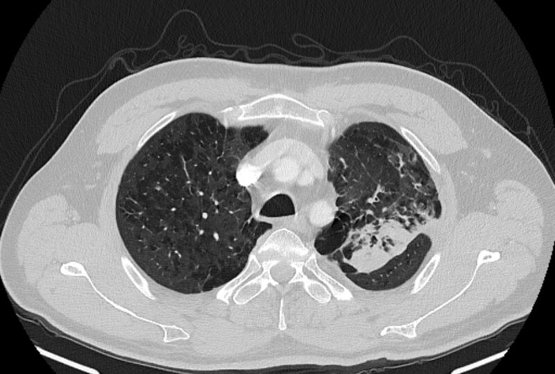 File:Brain metastases - lung cancer primary (Radiopaedia 75060-86116 Axial lung window 11).jpg