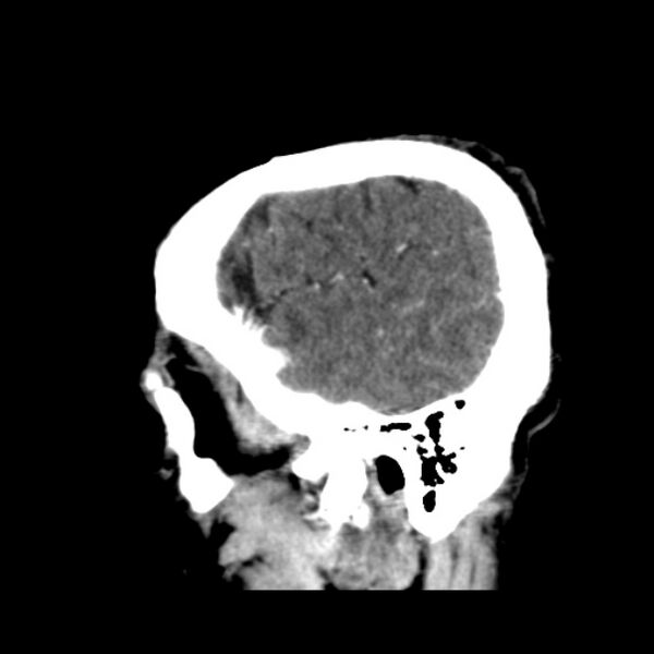 File:Brain metastases from lung cancer (Radiopaedia 24480-24781 C+ delayed 50).jpg
