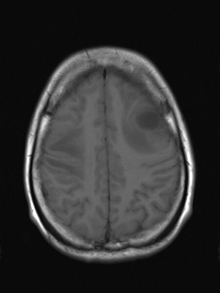 File:Brain metastasis as initial presentation of non-small cell lung cancer (Radiopaedia 65122-74126 Axial T1 15).jpg