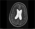 Brainstem glioma (Radiopaedia 21819-21775 Axial T2 25).jpg