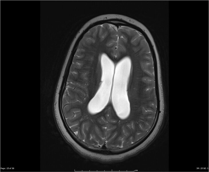 File:Brainstem glioma (Radiopaedia 21819-21775 Axial T2 25).jpg