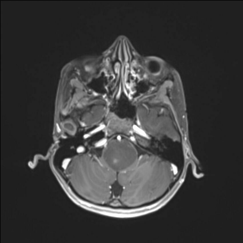 Brainstem glioma (Radiopaedia 70548-80674 Axial T1 C+ 38).jpg