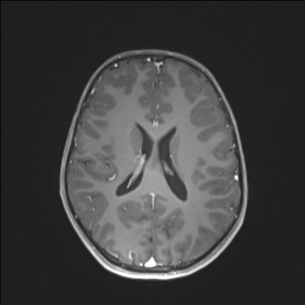 File:Brainstem glioma (Radiopaedia 70548-80674 Axial T1 C+ 98).jpg