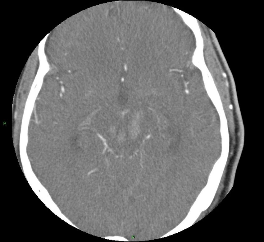 Brainstem hemorrhage (Radiopaedia 58794-66028 D 85).jpg