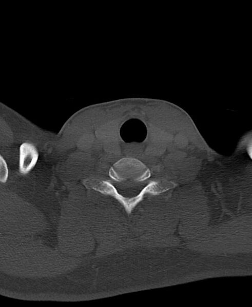File:Branchial cleft cyst (Radiopaedia 31167-31875 Axial bone window 57).jpg
