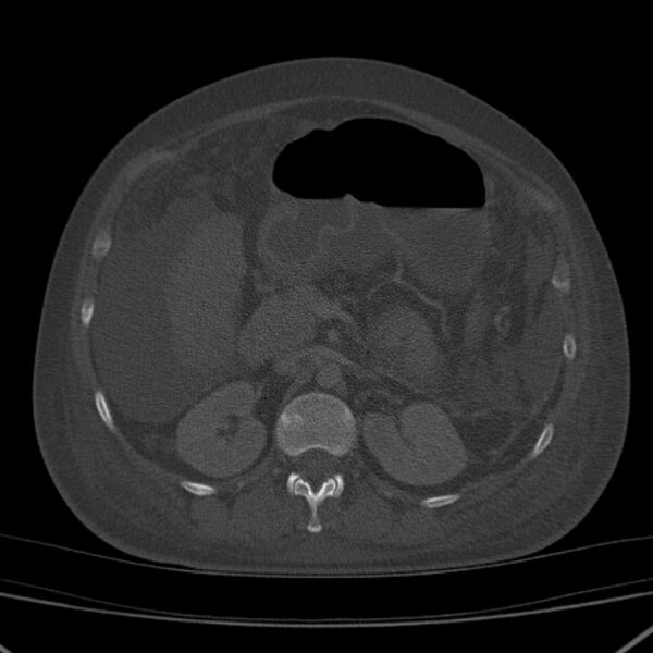 File:Breast cancer metastases - hepatic and skeletal (Radiopaedia 34201-35461 Axial bone window 52).jpg