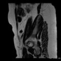 Broad ligament fibroid (Radiopaedia 49135-54241 Sagittal T2 25).jpg