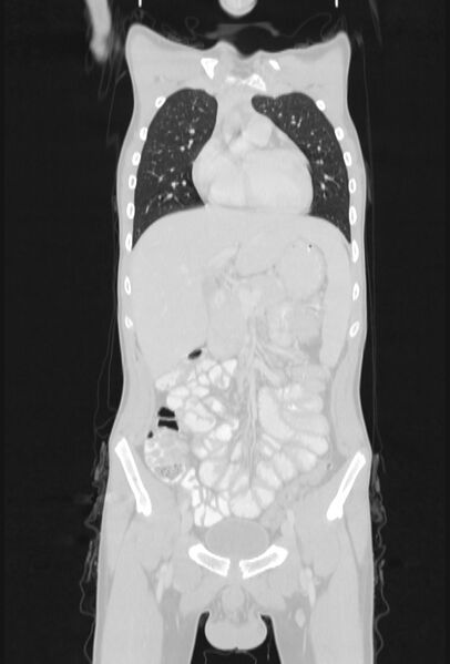 File:Bronchial carcinoid tumor (Radiopaedia 57187-64090 Coronal lung window 28).jpg