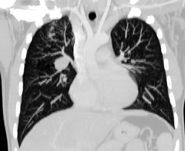 File:Bronchocele (Radiopaedia 12104-12460 Coronal lung window 8).jpg