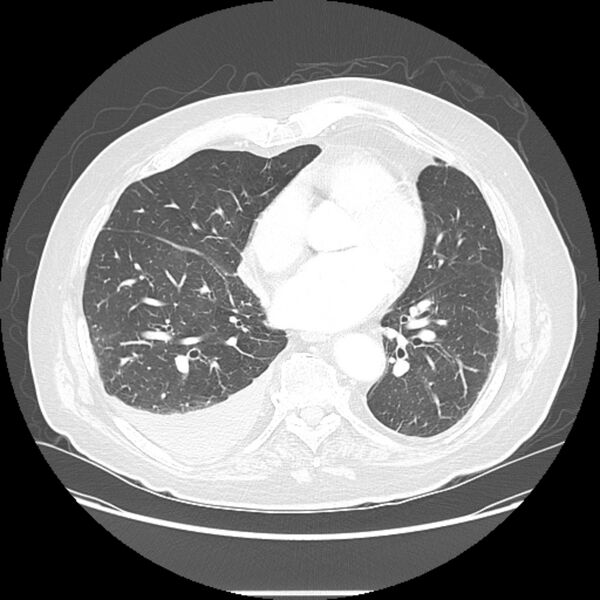 File:Bronchogenic adenocarcinoma and pulmonary embolism (Radiopaedia 9097-9806 Axial lung window 19).jpg