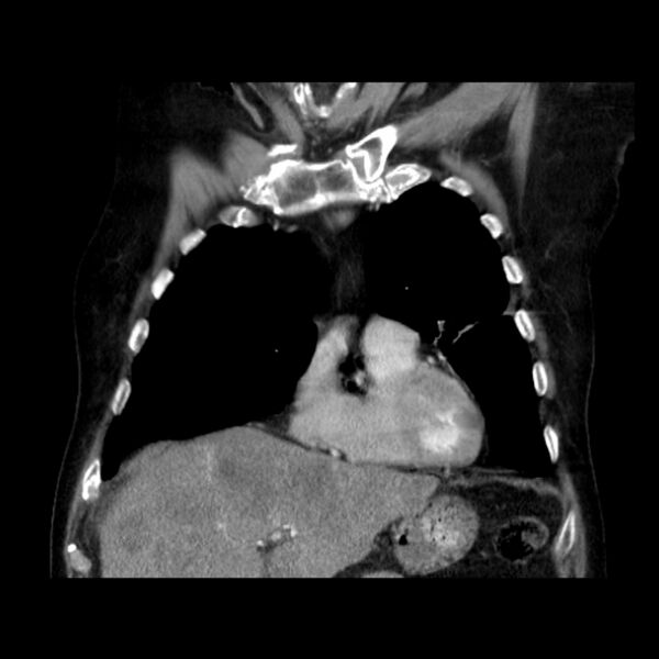 File:Bronchogenic adenocarcinoma and pulmonary embolism (Radiopaedia 9097-9806 C 13).jpg