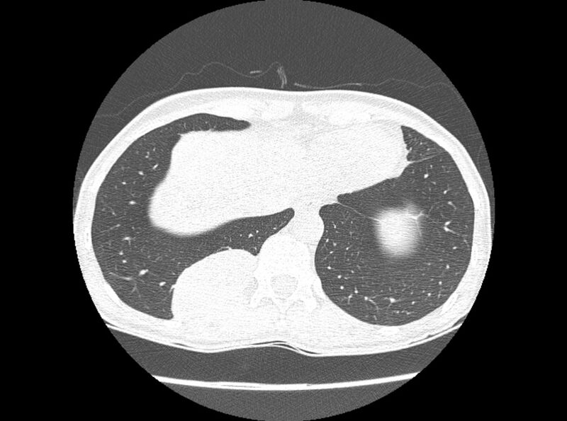 File:Bronchogenic cyst (Radiopaedia 80273-93615 Axial lung window 24).jpg