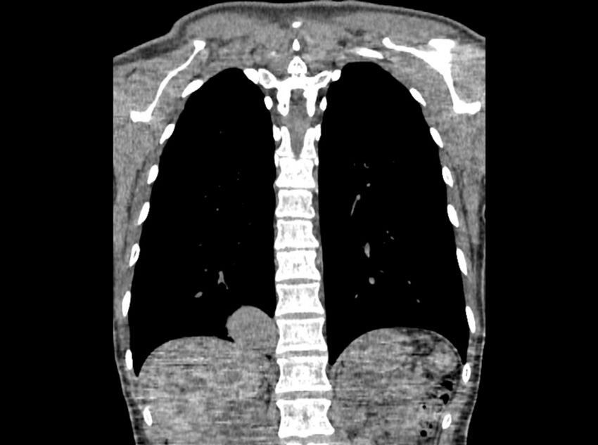 Bronchogenic cyst (Radiopaedia 80273-93615 D 89).jpg