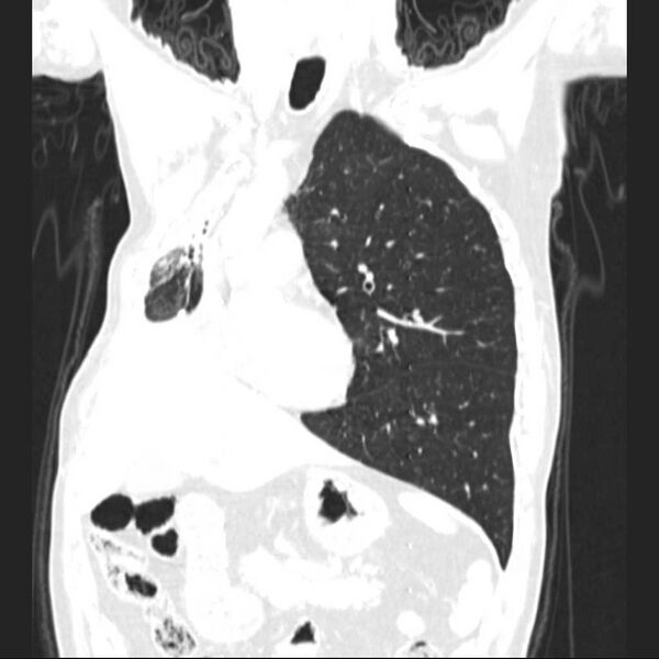 File:Bronchopleural fistula - postoperative complication (Radiopaedia 21020-20947 Coronal lung window 11).jpg