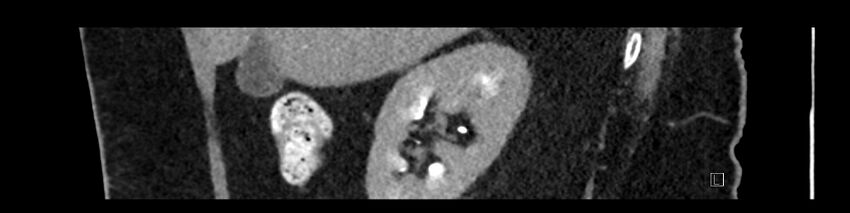 Buried bumper syndrome - gastrostomy tube (Radiopaedia 63843-72575 Sagittal Inject 93).jpg